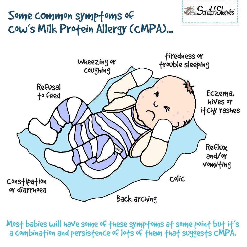 Cartoon of unhappy baby showing symptoms of cows milk protein allergy. Refusal to feed; wheezing or coughing; tiredness or trouble sleeping; colic; constipation or diarrhoea; back arching; reflux and/or vomiting; eczema, hives or itchy rashes. Most babies will show some of these symptoms at some point, it's the combination and persistence that suggests CMPA.