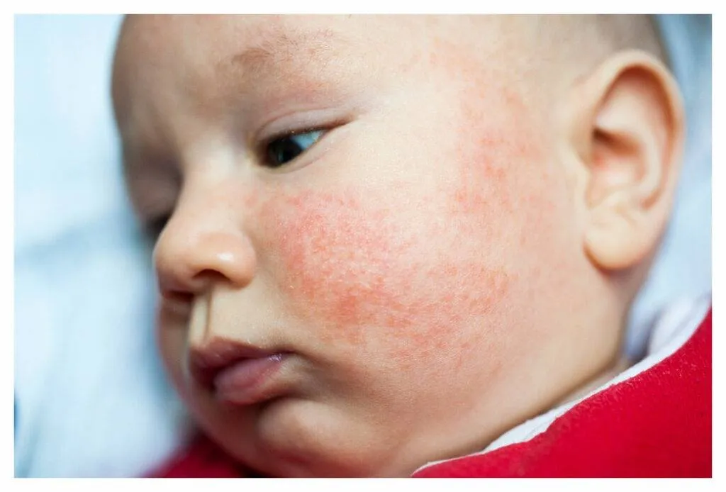 Asian baby with red baby eczema over his cheeks and forehead. The spots are not clearly defined and the skin between is inflamed